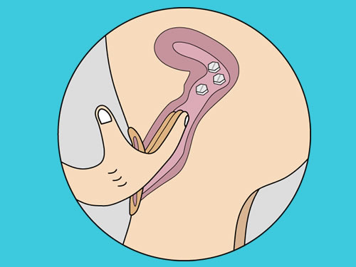 cytotec via vaginal quito